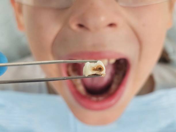 Best Emergency Dentist for Lost Fillings or Crowns in Roselle Park, NJ